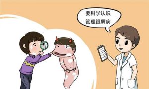 阿普斯特是如何治疗银屑病的？